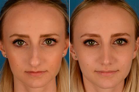 Bestof You Top Bulbous Nose Rhinoplasty Before And After In 2023 Check