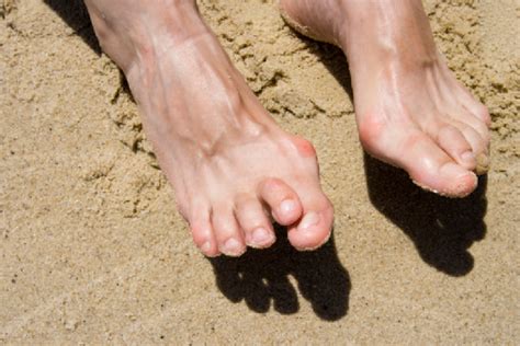 Overlapping Toes Achilles Podiatry