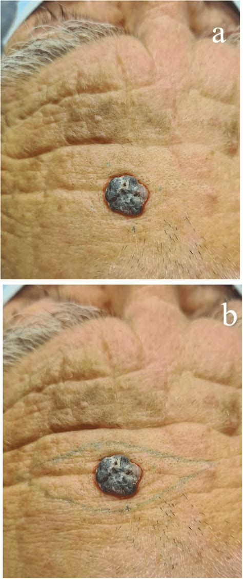 Basal Cell Carcinoma Of The Forehead Control Only Clinically