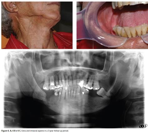 Osteoradionecrosis Radiograph