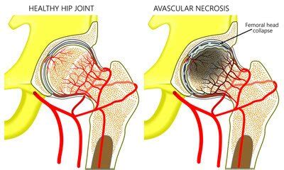 Athletes With Osteonecrosis Or Avascular Necrosis Avn Dr Lox