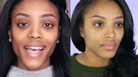 Unless they have the passcode. Removing DARK CIRCLES: (My Under Eye Fillers Experience ...