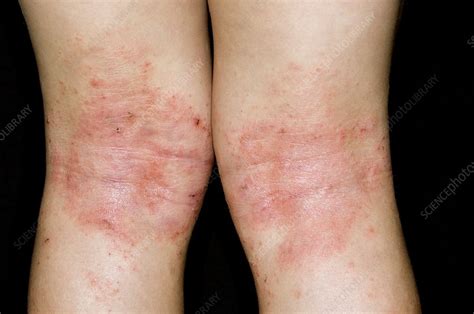 Atopic Eczema On Back Of Knees Stock Image C0083614 Science Photo