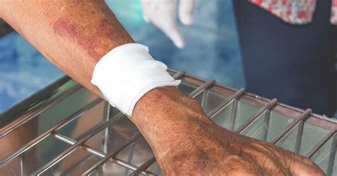 You're more likely to get them if you: Blood Clot in Arm: Symptoms, Treatment, Prevention, and More