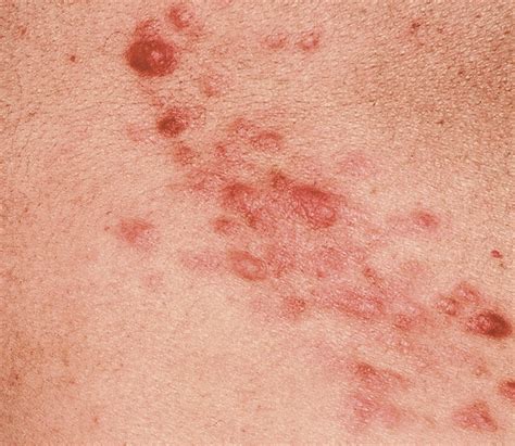Multiple Painful Cutaneous Nodules—quiz Case Dermatology Jama