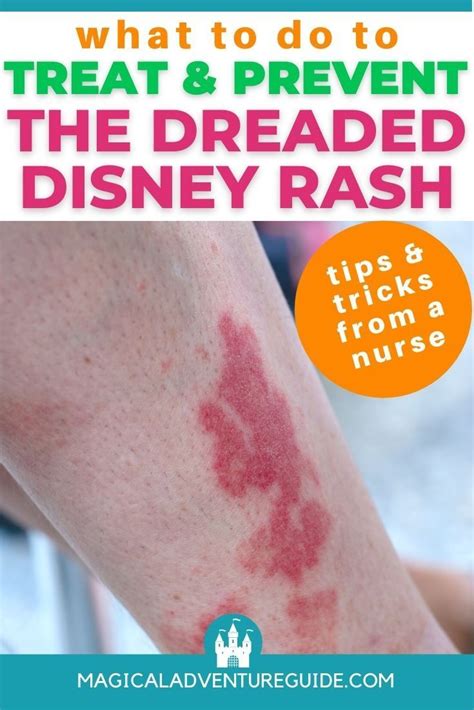 Have You Heard Of The Disney Rash Learn More About What Causes It So