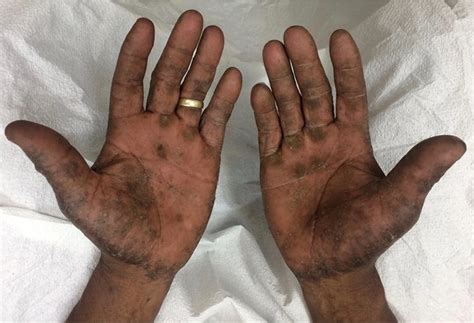 Hyperkeratosis Of The Palms Due To Chromate Irritant And Allergic