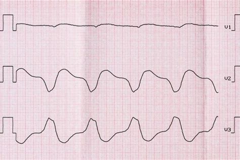 What Is Ventricular Fibrillation Facty Health