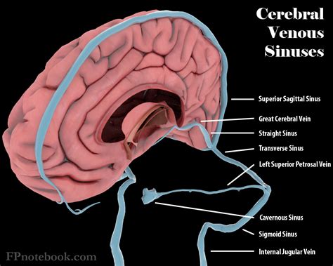 Cerebral Venous Sinus Thrombosis : Cerebral Venous Sinus Thrombosis And Iron Deficiency Anemia ...