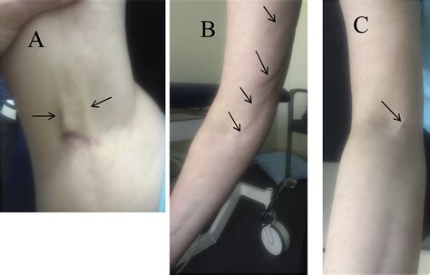 Review Of Axillary Web Syndrome What The Radiologist Should Know