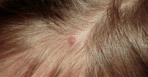 Share More Than 82 Pimples In Hair Scalp Latest Ineteachers