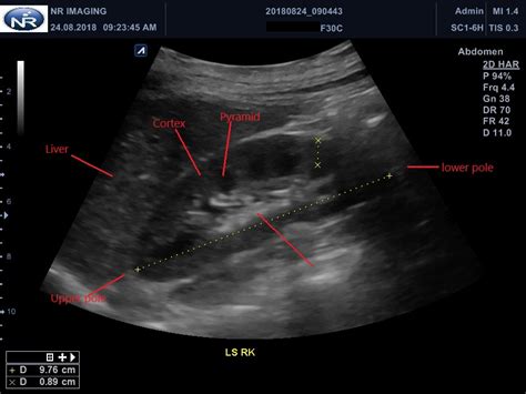Kidney Ultrasound Labeled