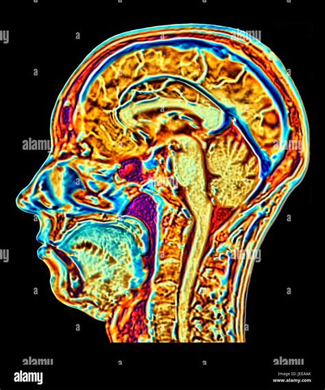 Normal Brain Mri Hi Res Stock Photography And Images Alamy