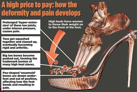 High Heels 3d Scan Shows Stilettos Cause Unsightly Clawed Toes