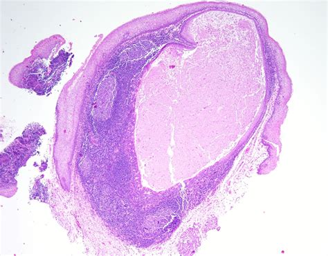 Pathology Outlines Lymphoepithelial Cyst