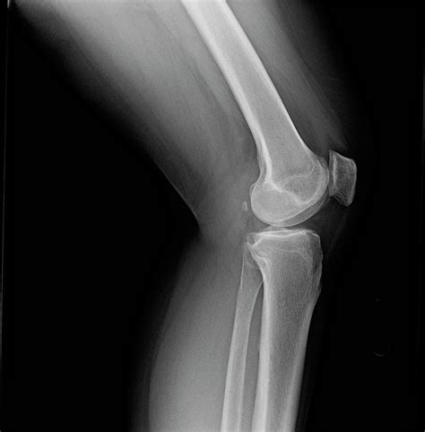 Left Knee Joint X Ray Of Mature Female With Osteoarthritis Photograph