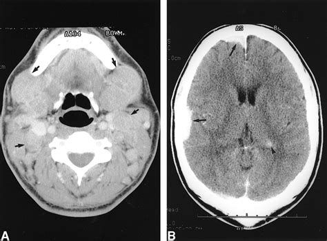 Rosai Dorfman Disease Presenting With Isolated Bilateral Orbital Masses