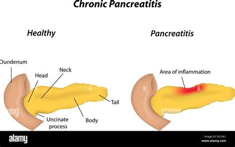 Pancreatitis Hi Res Stock Photography And Images Alamy