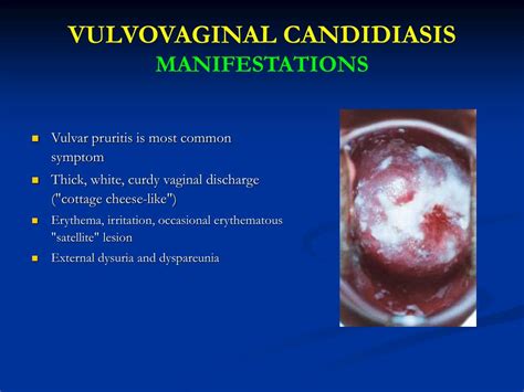 Vulvovaginal Candidiasis Db Clinic Sexiezpix Web Porn