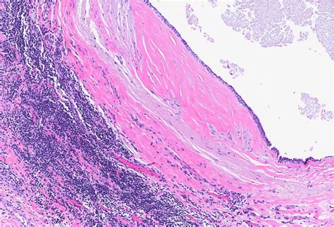 Pathology Outlines Microcysts