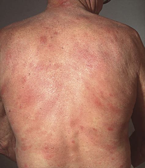 Granulomatous Mycosis Fungoides And Granulomatous Slack Skin A