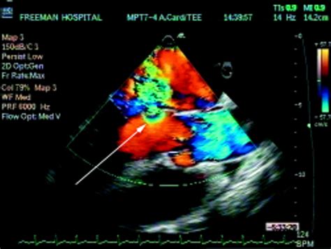 Perforated Mitral Valve Leaflet Heart