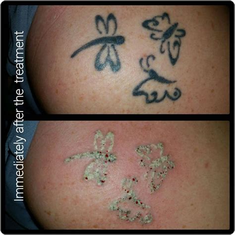 Laser Tattoo Removal Forever Clinic Cheltenham Aesthetics