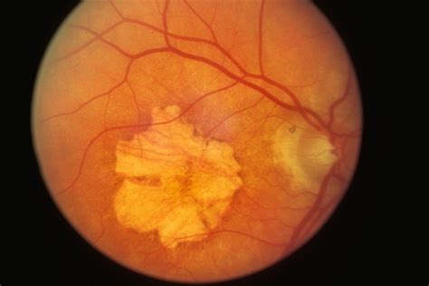 Macular Atrophy Retina Image Bank
