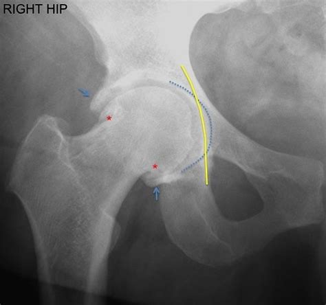 Types Of Fractures Impingement Rad Tech Hip Dysplasia Abnormal