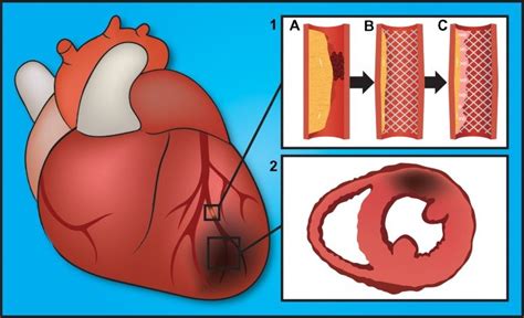 Coronary Heart Disease Cartoon