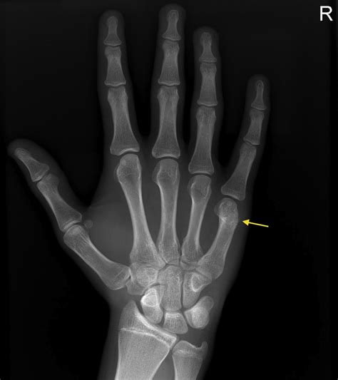 Boxers Fracture Radiology At St Vincents University Hospital