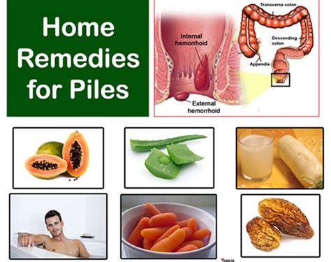 Piles Home Remedies Best Treatment For Piles At Home