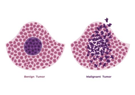 Benign Vs Malignant Tumors Whats The Difference