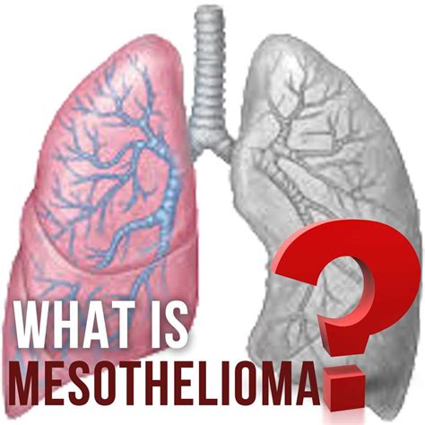 How Do You Get Mesothelioma Jandils Attorneys