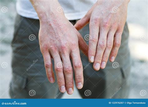 Psoriasis Vulgaris On The Mans Hands With Plaque Rash And Patches On