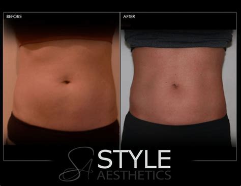 Coolsculpting Weight Loss Fat Removal Reduction Before After Photos Web Portland Oregon 0428