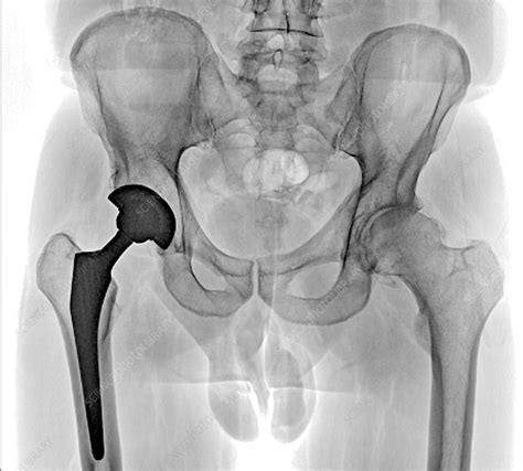 Total Hip Replacement X Ray Stock Image C040 3277 Science Photo Library