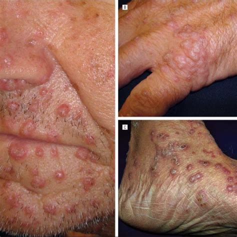 Figure Clinical Images Of The Study Patient A Xerosis And Ichthyosis
