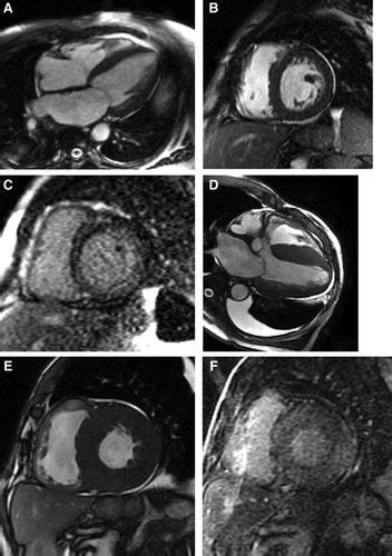 Transthyretin Cardiac Amyloidosis In Black Americans Circulation Heart