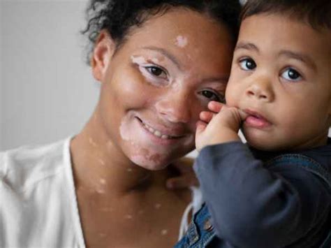 Vitiligo On Lips Learn Treatment And Prevention Now Tv Health