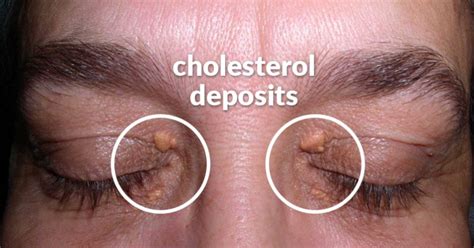 Cholesterol Deposits Around The Eyes Are A Sign Of High Cholesterol