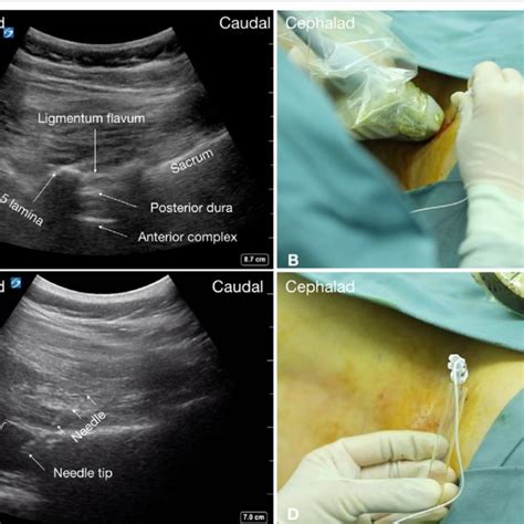 Real Time Ultrasound Guided Lumbar Puncture In A Sma Patient With