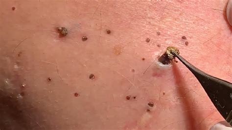 Blackheads can be annoying, unsightly, and difficult to manage. Pimple Popping 2020 Video #56| Blackhead removal ...