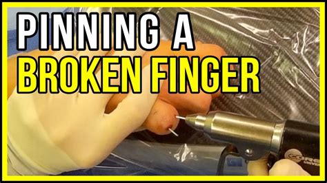 Fixing A Finger Fracture With Pins Youtube