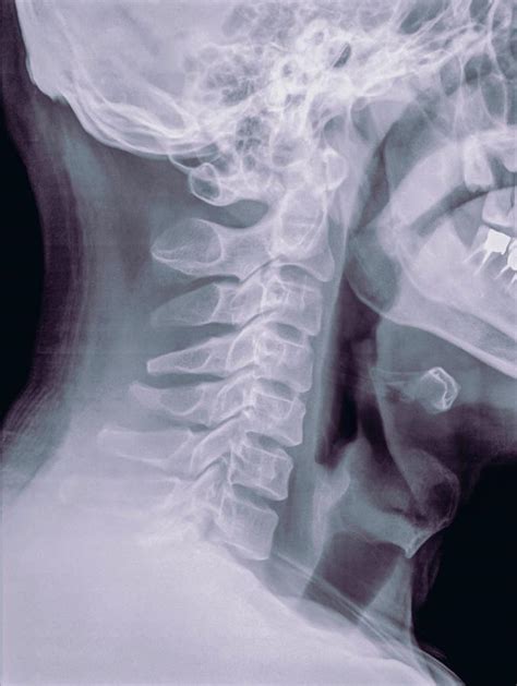 Cervical Spine X Ray Photograph By Photostock Israel