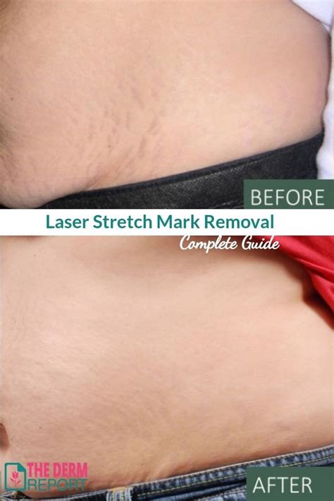 Laser Stretch Mark Removal A Guide To Laser Treatments For Stretch