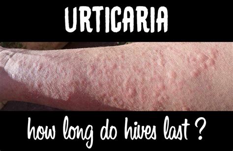 How Long Do Hives Last After An Allergic Reaction