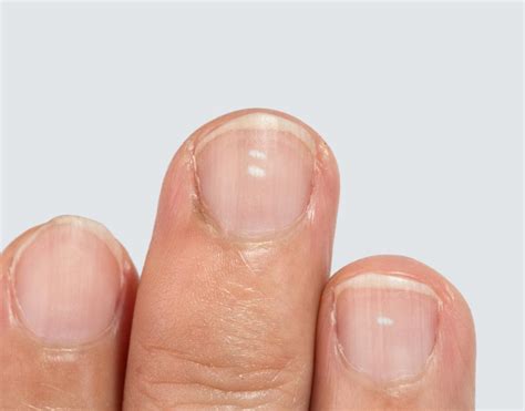 Taches Blanches Sur Les Ongles Causes Prévention Et Traitement