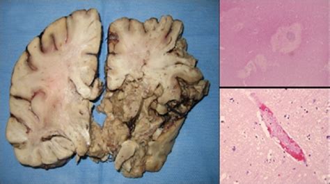 A Autopsy Brain Section Demonstrates Extensive Right T Open I
