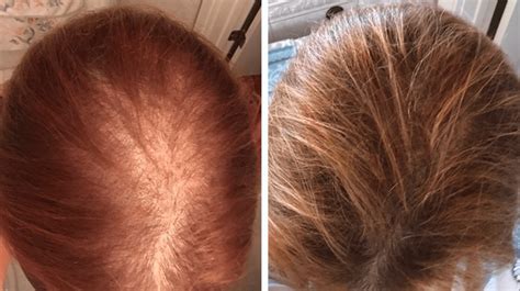 Grow Thicker Fuller Hair Fast With A Fda Cleared Laser Hair Growth